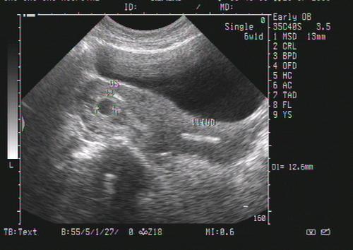 怀孕10周胚芽大小正常值 专家解答准妈妈需了解