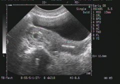 怀孕10周胚芽大小正常值 专家解答准妈妈需了