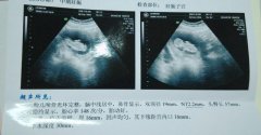 如何从孕囊和胎心看胎儿性别