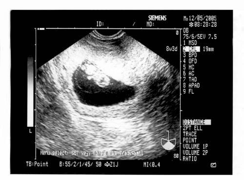 如何从孕囊和胎心看胎儿性别