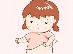 长痱子怎么办 ​关于痱子的误区