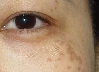 产后脸上长斑怎么办 产后脸上的斑要多久才消失